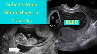 Subchorionic Hemorrhage ultrasound 12 weeks [upl. by Le191]