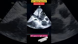 IVC Echo I subcostal view l echo shorts [upl. by Giorgio684]