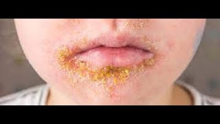 What is impetigo  Impetigo Signs and Symptoms Causes Prevention [upl. by Anilam]