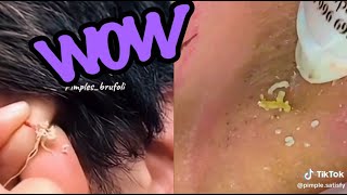 Top Satisfying Pimple Pops of 2024 Blackheads Cysts and More [upl. by Milas325]