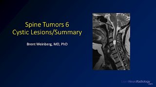 Spine tumors 6 – Cysts and Summary [upl. by Hoeve641]