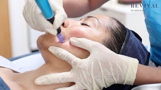 Microneedling Full Training Video [upl. by Santa]