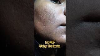 Day27 Using Tretinoin 0025 cream viralvideo tretinoin tretinoincream shorts youtubeshorts [upl. by Eenimod]