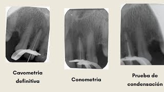 Endodoncia 22 [upl. by Inaffyt]