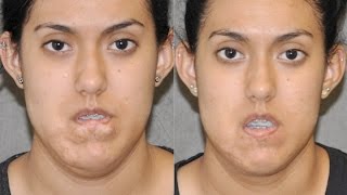 Best Scar Removal and Hemangioma Revision Beverly Hills Plastic Surgeon Face Neck Lip contouring [upl. by Anawit]