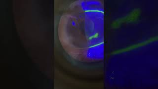 Dendritic corneal ulcer [upl. by Coffeng702]