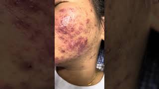 Acne peeling for severe acne [upl. by Kcirded136]