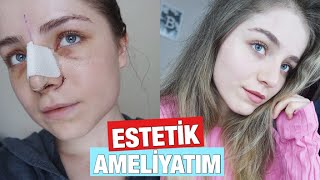 BAŞTAN SONA BURUN ESTETİĞİ AMELİYATIM  Fotoğraflar Vlog ve SoruCevap [upl. by Whitby78]