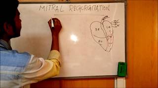 MITRAL REGURGITATION  DEFINITIONCAUSESSIGNSSYMPTOMSPATHOPHYSIOLOGY AND TREATMENT [upl. by Atena]