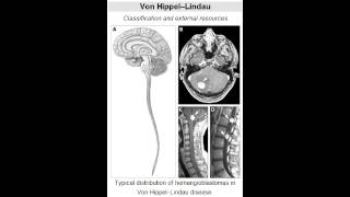 von HippelLindau disease dominant tumor suppressor gene mutation [upl. by Inilam]