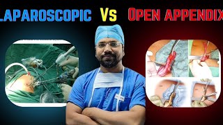 Laparoscopic vs open appendectomy l educationalvideo appendicitis surgeons jamui yt trending [upl. by Meghan]