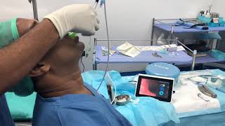 Awake self intubation through a Supraglottic device [upl. by Stein]