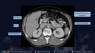 TOMOGRAFIA AXIAL BASICA DE ABDOMEN Y PELVIS [upl. by Mendes]