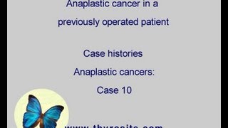 Anaplastic thyroid carcinoma  case 10 [upl. by Antipus70]