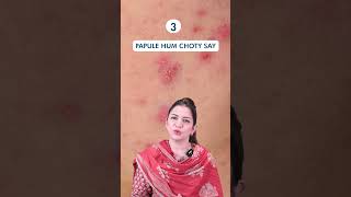 6 Types Of Acne Acne Pimples blackheads [upl. by Wahlstrom169]