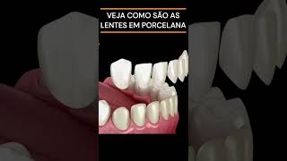 LENTES EM PORCELANA NOS DENTES lentedentaria lentedecontatodental oral bucal porcelana odonto [upl. by Lindley]