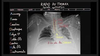 Radio du thorax  ABCDEFGHI  Partie 2  Docteur Synapse [upl. by Atineb]