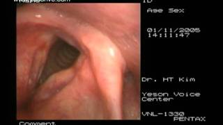 Laryngoplasty of sulcus vocalis [upl. by Suravaj]