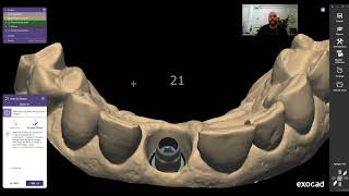 Exocad para PRINCIPIANTES Corona anterior sobre implante [upl. by Acsicnarf65]