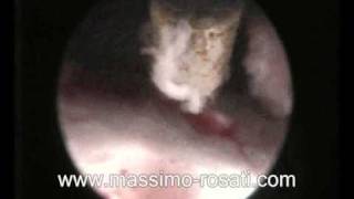 Endoscopical Treatment Of A Septum Pellucidum Cyst [upl. by Alin]