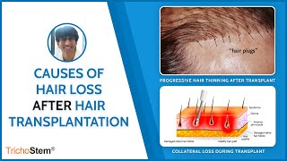 Possible Causes of Hair Loss after Hair Transplant [upl. by Aidole]