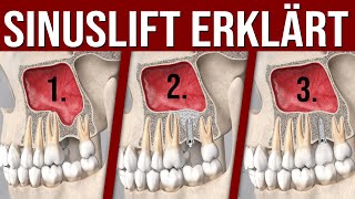 So funktioniert ein externer Sinuslift Knochenaufbau in der Kieferhöhle [upl. by Jonis]