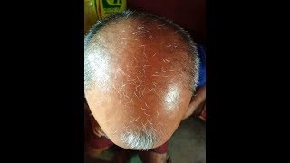 Jonk Ka Tel  The Best Hairfall Treatment [upl. by Jezabel]