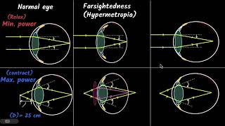 Defects of vision  The human eye and the colourful world  Physics class 10  Khan Academy [upl. by Keenan]