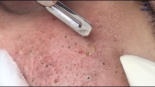 Full Blackhead Popping Video  HOT 2019  Part 2  Continue [upl. by Sined465]