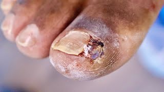 His Last Surgery FAILEDJUICY INFECTED INGROWN TOENAIL [upl. by Nahama]