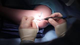 Cubital Tunnel Release Surgery  James D Baker MD [upl. by Ahmad]