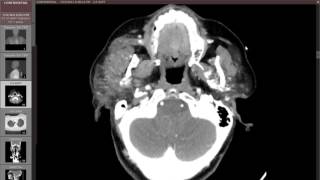 Parotitis with parotid duct stone [upl. by Aenel394]