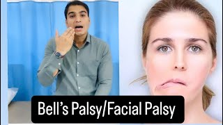 Bells Palsy  Facial Palsy Best Tips and exercise Fast Recovery Dr Pritam Singh [upl. by Aem628]