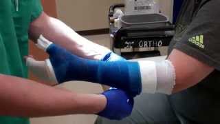 Application of a Thumb Spica Cast [upl. by Zetrauq]