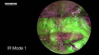 RealTime Fluorescence Infrared Laparoscopy  How it works [upl. by Anrahc474]