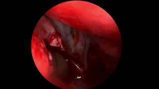 Functional Endoscopic Sinus Surgery FESS for Antrochoanal Polyp Dr Abu Raihan Alberuni [upl. by Agn]