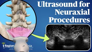 Ultrasound for Neuraxial Procedures [upl. by Floria161]