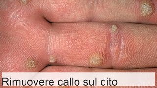 Calllosità sul dito o sul palmo come trattare rimedi per calli secchi [upl. by Eneryc]