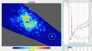 Wheal flare and axon reflex response from intradermal injection [upl. by Sedrul]