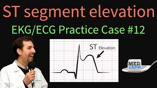 ST Elevation  EKG  ECG Interpretation Case 12 STEMI MI ACS [upl. by Docia]