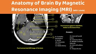 Brain Anatomy On an MRI Magnetic Resonance Imaging Scan [upl. by Adnana]