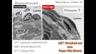 Lymph educational video vol2  Lymphedema Surgery in Japan  Mihara MD and Hara MD [upl. by Aleac]