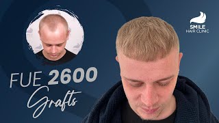 Hair Transplant 2600 Grafts BeforeAfter 12Month Journey at Smile Hair Clinic [upl. by Abramson]