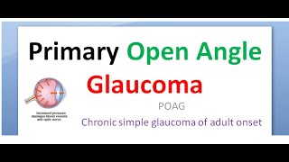 Ophthalmology 236 a Primary Open Angle Glaucoma POAG Symptom Classification risk factor Diurnal test [upl. by Nivla816]