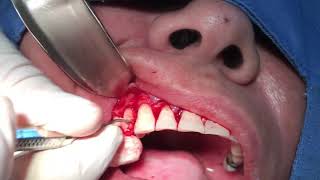 Curetaje periodontal abierto [upl. by Irv]