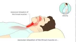 Obstructive Sleep Apnea Syndrome OSAS  Causes and treatment [upl. by Luben]