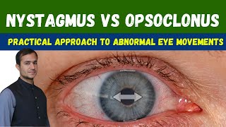 Nystagmus vs opsoclonus Nystagmus eye movements types opsoclonus myoclonus ataxia syndrome video [upl. by Ariem182]