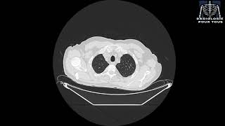 SCANNER THORACIQUE Épanchement pleural gauche responsable d’un collapsus passif du LIG [upl. by Hoffmann]