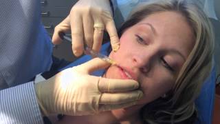 Juvederm Lip Augmentation in Richmond VA [upl. by Rufford]