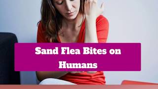 Sand Flea Bites On Humans [upl. by Auka]